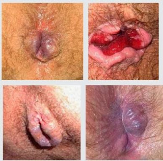 Illustration for article titled Obat Apotik Mengempeskan Benjolan Di Anus Sembuh Total